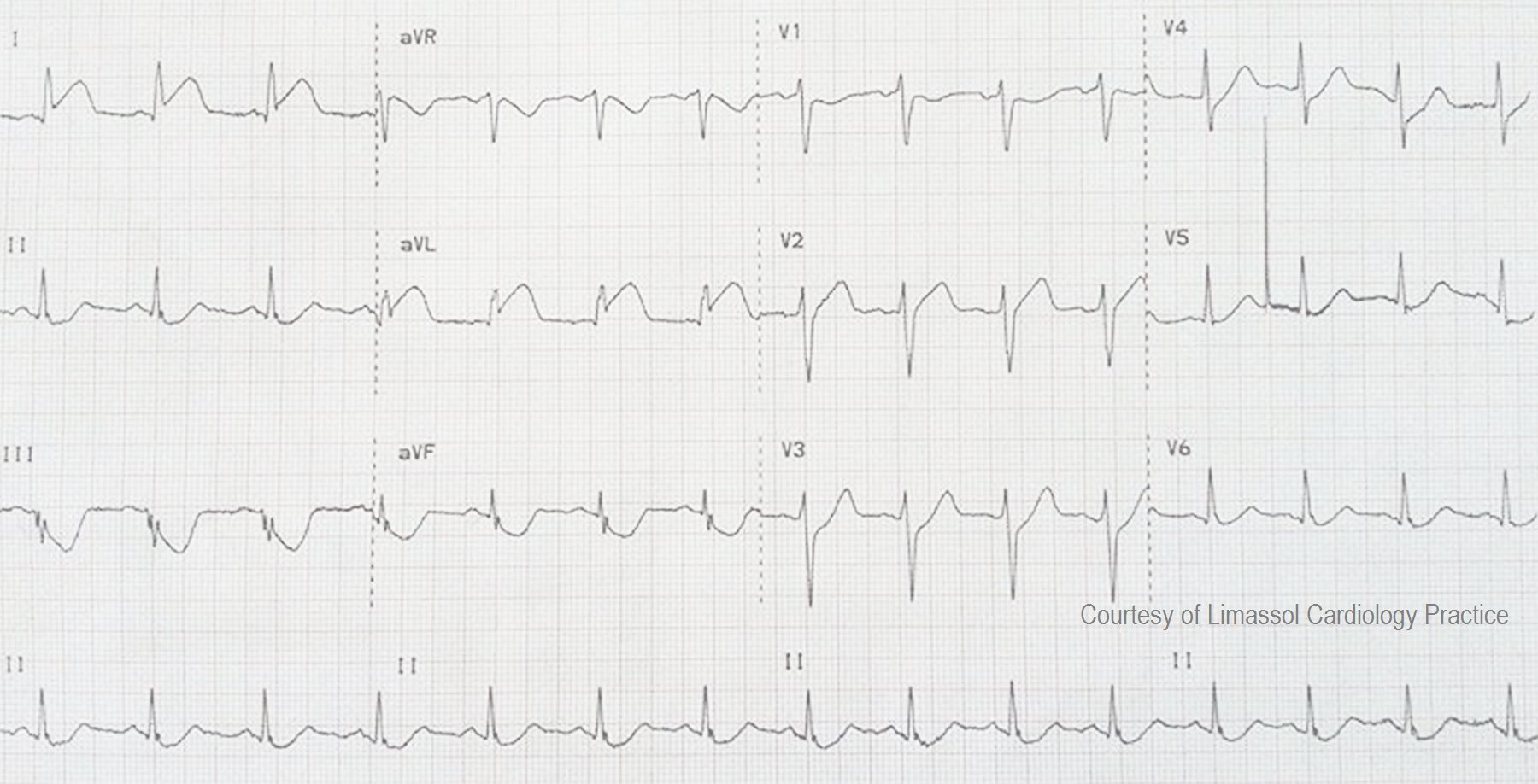 acute-lateral-wall-m-i-ecg-guru-instructor-resources